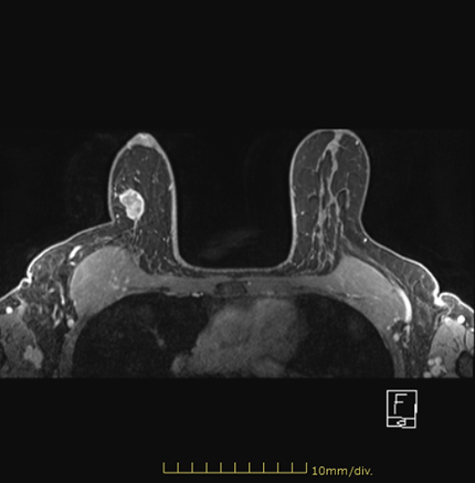 乳癌 乳房腫瘍5 ｜ Search Radiology ｜ 医療関係者向け情報