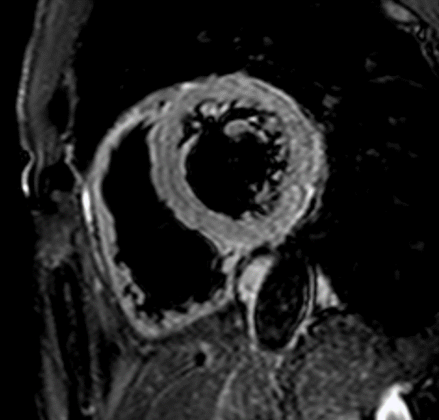 非虚血性心疾患 ｜ Search Radiology ｜ 医療関係者向け情報