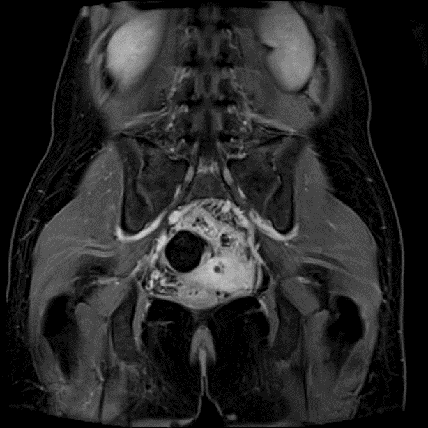 卵巣腫瘍 ｜ Search Radiology ｜ 医療関係者向け情報