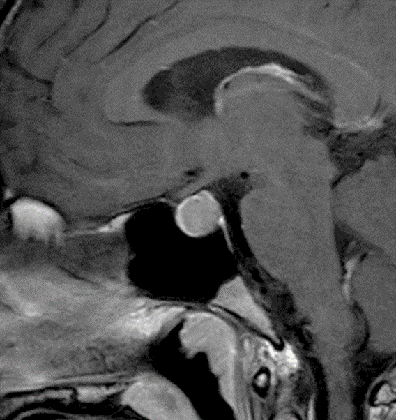 下垂体2 | Search Radiology | 医療関係者向け情報 下垂体2 | Search Radiology | 医療関係者向け情報