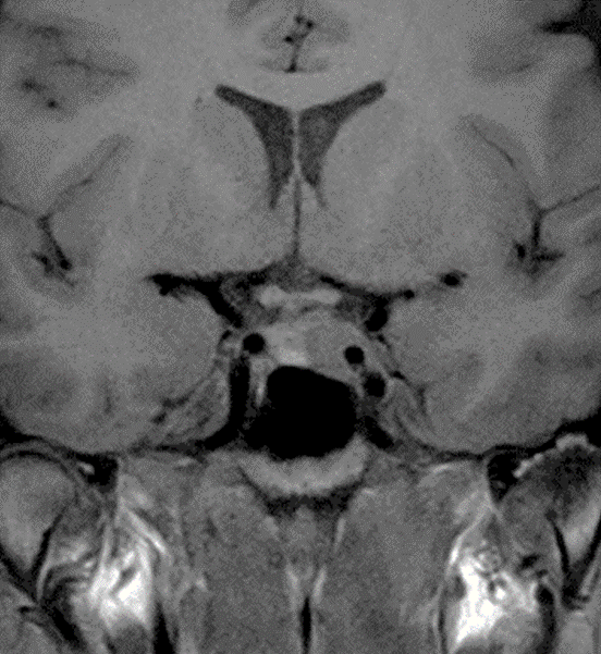 下垂体2 ｜ Search Radiology ｜ 医療関係者向け情報