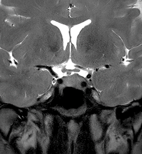 下垂体2 | Search Radiology | 医療関係者向け情報 下垂体2 | Search Radiology | 医療関係者向け情報