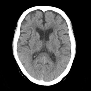 下垂体2 | Search Radiology | 医療関係者向け情報 下垂体2 | Search Radiology | 医療関係者向け情報