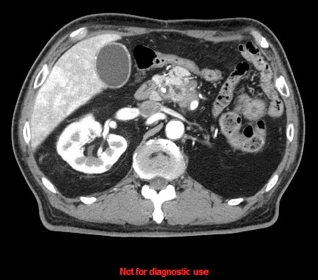 膵ダイナミックCT(2) ｜ Search Radiology ｜ 医療関係者向け情報