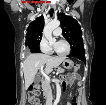 胸-腹部造影CT（肺精査）1 ｜ Search Radiology ｜ 医療関係者向け情報