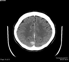 下垂体腫瘍 ｜ Search Radiology ｜ 医療関係者向け情報