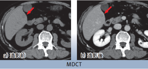 転移性肝癌(Practical report)（3T MRIを用いた転移性肝癌の診断 
