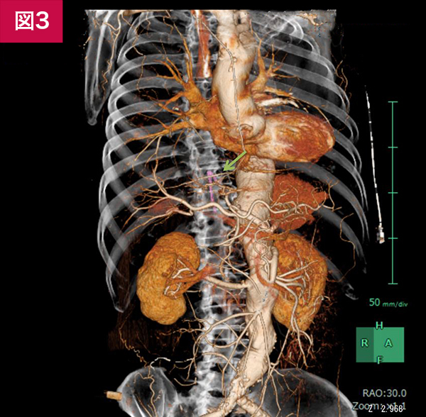 胸腹部大動脈瘤の術前精査: Adamkiewicz動脈の同定 ｜ Search 