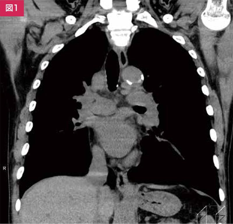 肺がんTACE前の胸腹部造影CT ｜ Search Radiology ｜ 医療関係者