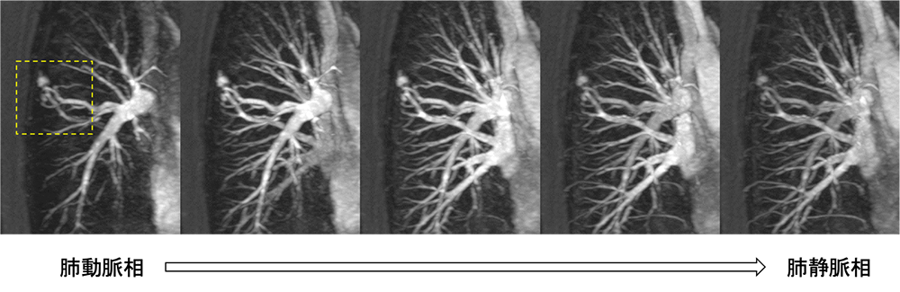 高時間分解能MRAによる肺動静脈奇形の塞栓術前・術後評価 ｜ Search