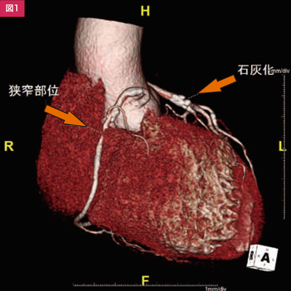 冠動脈CT（Coronary CT）により狭窄病変を認めた症例 ｜ Search Radiology ｜ 医療関係者向け情報