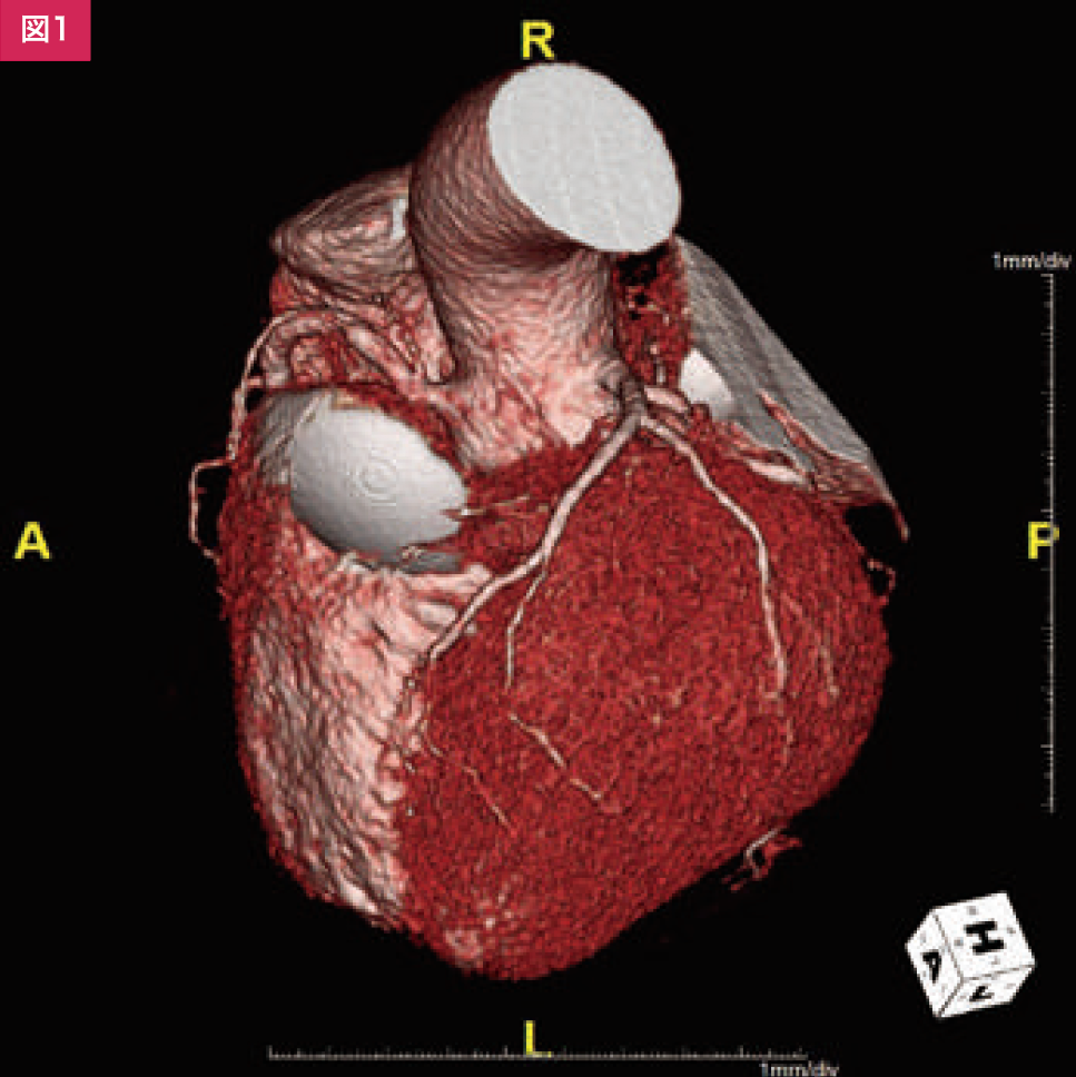冠動脈，大動脈の同時撮影により冠動脈に閉塞及び狭窄病変を認めた症例 