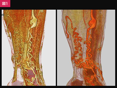 下肢静脈奇形切除術及び大腿皮弁術の術前検査 ｜ Search Radiology 