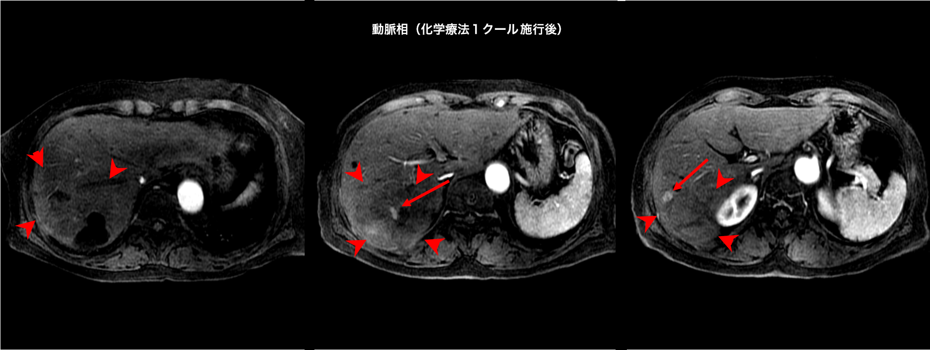 エビデンスからせまる肝のMRI エビデンスからせまる 肝のMRI - 撮像から診断まで - | 本杉