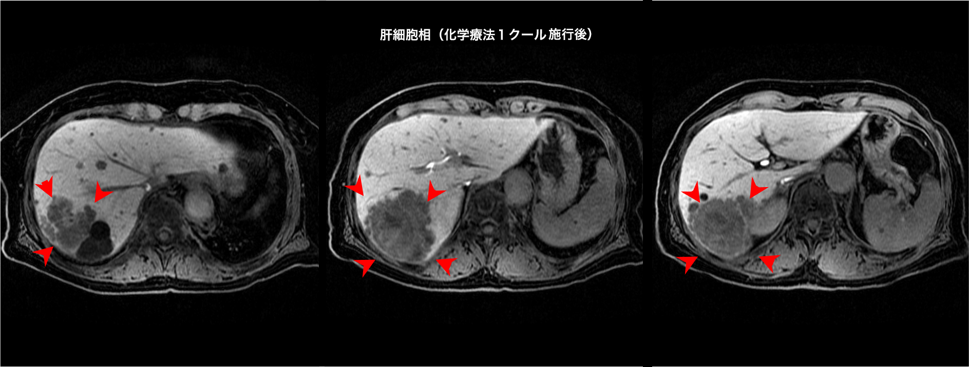 肝細胞癌、分子標的薬治療後の効果判定におけるEOB-MRIの有用性 