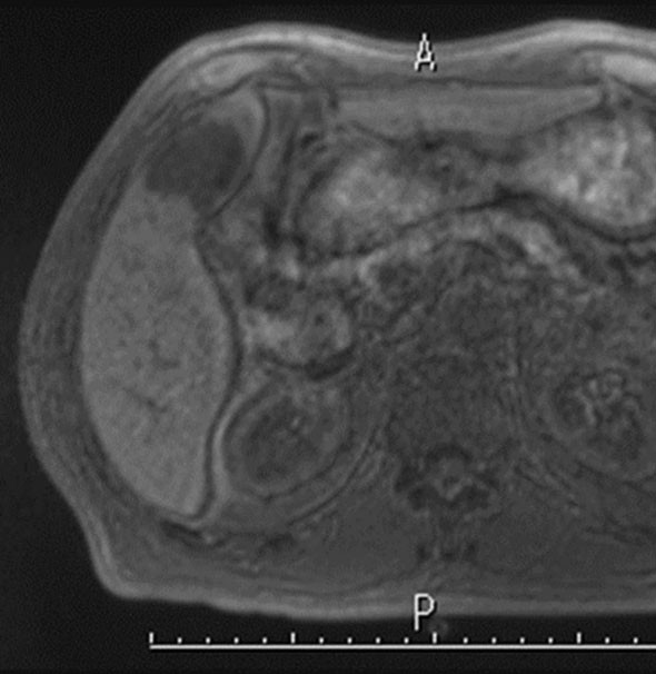EOB-MRI/Sonazoid超音波による肝癌の診断と治療 EOB-MRI/Sonazoid 超音波による肝癌の診断と治療 | 工藤 正俊