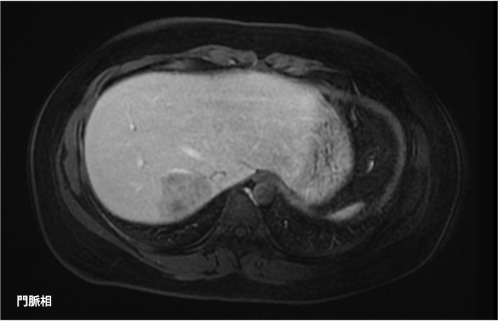 肝細胞腺腫の亜型診断にEOB-MRIが有用であった症例 ｜ Search