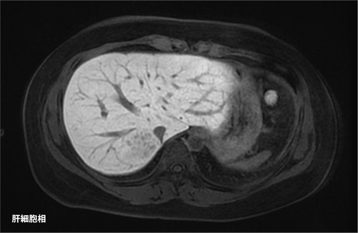 肝細胞腺腫の亜型診断にEOB-MRIが有用であった症例 ｜ Search