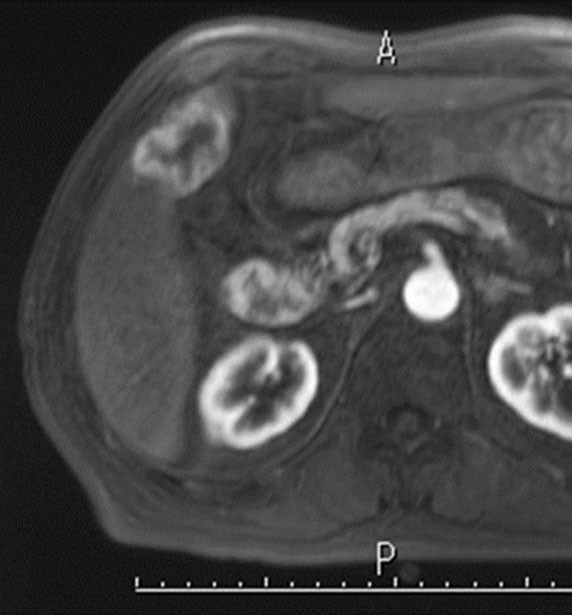 EOB-MRI/Sonazoid超音波による肝癌の診断と治療 EOB-MRI/Sonazoid 超音波による肝癌の診断と治療 | 工藤 正俊
