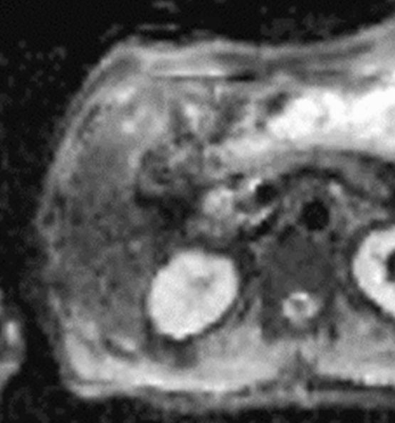 EOB-MRI/Sonazoid超音波による肝癌の診断と治療 EOB-MRI/Sonazoid 超音波による肝癌の診断と治療 | 書籍詳細