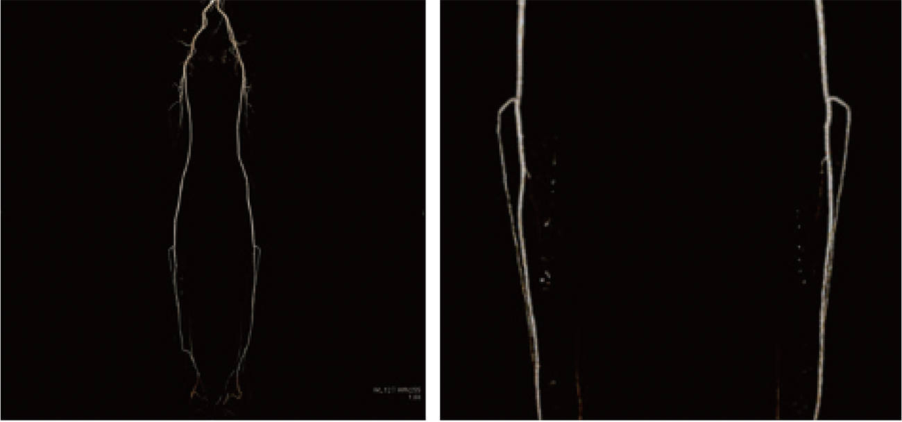 低電圧撮像における、サブトラクションを用いた下肢動脈の描出