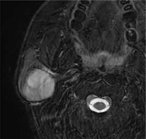 多形腺腫におけるダイナミック造影の有用性 ｜ Search Radiology