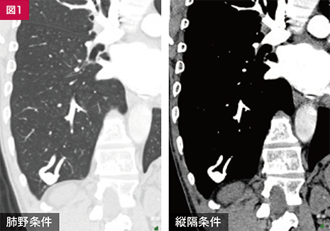 ファロー四徴症（TOF）術後の血管形態評価 ｜ Search Radiology