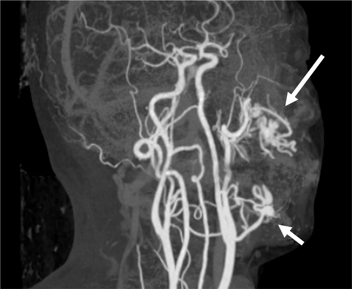 造影CTを用いた頬間隙AVM術前評価の一例 | Search Radiology 造影CTを用いた頬間隙AVM術前評価の一例 | Search Radiology