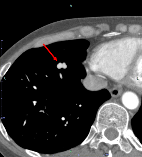 腎機能不良患者における造影剤半量での大動脈CT ｜ Search