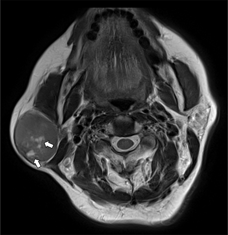 【裁断】唾液腺疾患のMRI ガドビスト造影MRIによる顎下腺腫瘍の診断 ｜ Search Radiology