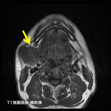 ガドビスト造影MRIによる顎下腺腫瘍の診断 ｜ Search Radiology