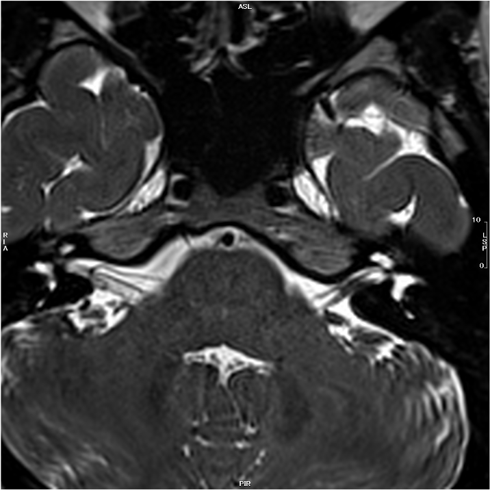 Bell麻痺における造影T1強調画像の有用性 ｜ Search Radiology