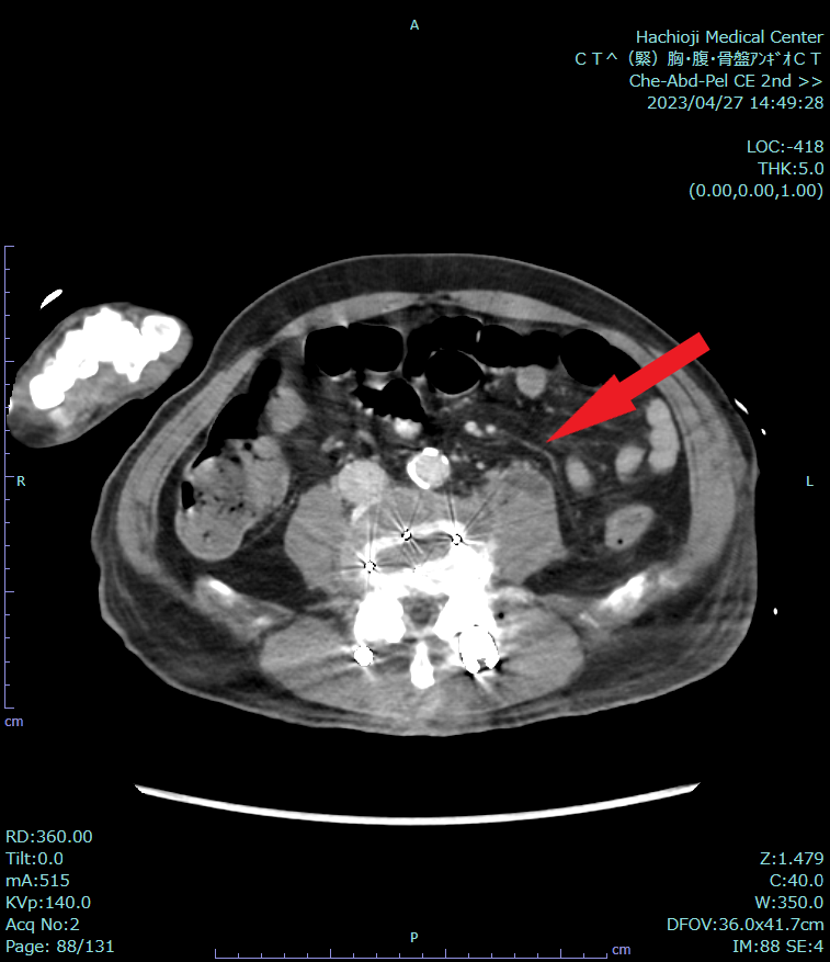 肺動脈血栓の検出に有用であった一例 ｜ Search Radiology