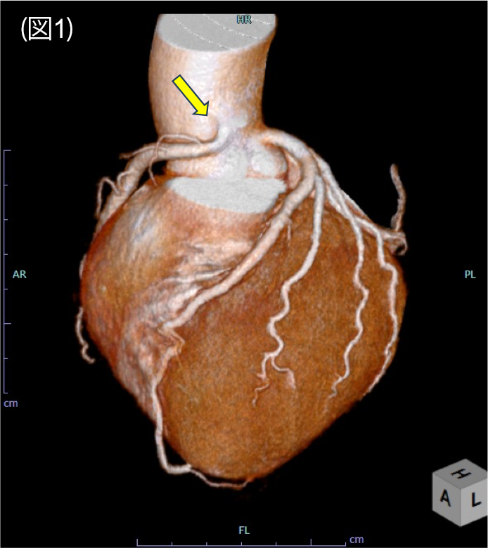 右冠動脈起始異常の一例 ｜ Search Radiology ｜ 医療関係者向け情報