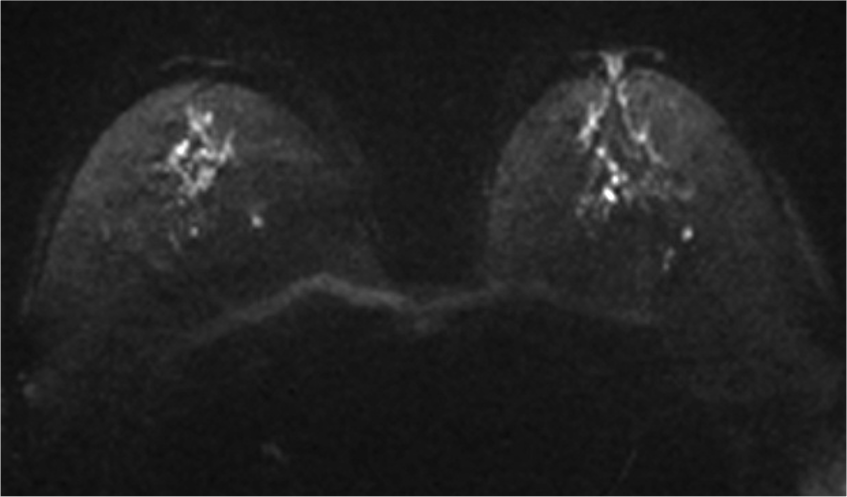 特殊型乳癌：浸潤性小葉癌 ｜ Search Radiology ｜ 医療関係者