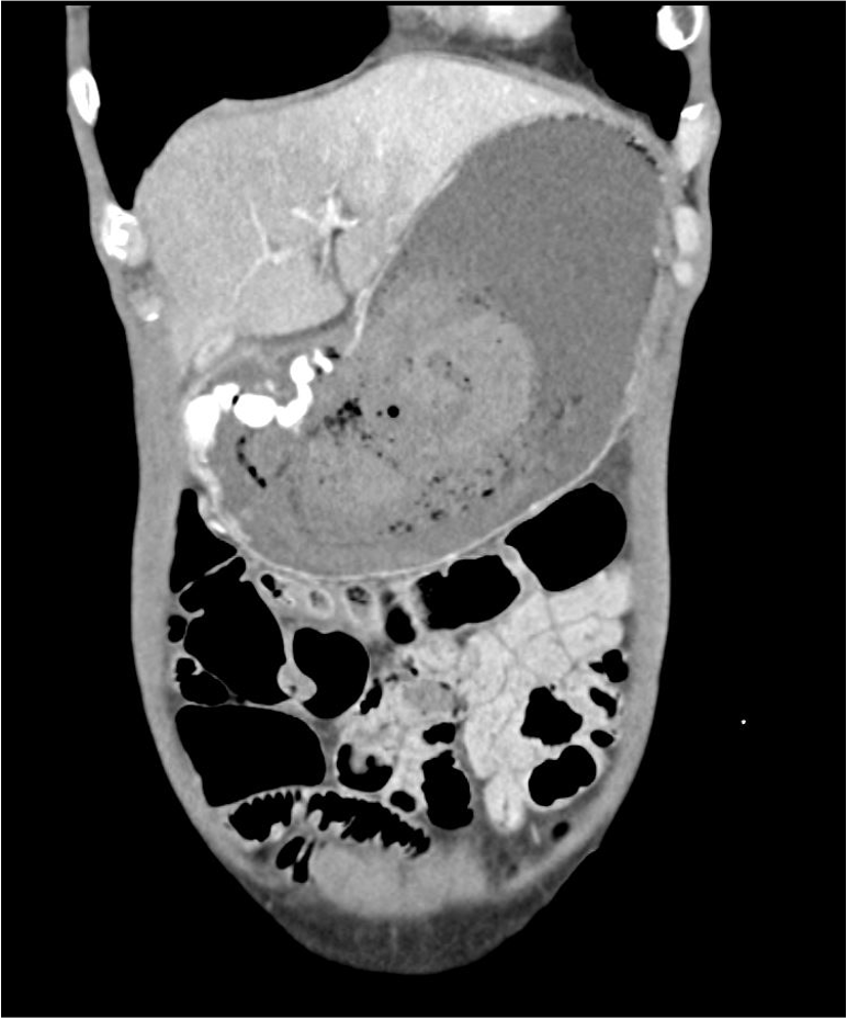 消化管疾患 消化器内科 第28号(Vol.4 No.3,2022)特集:体外式超音波による