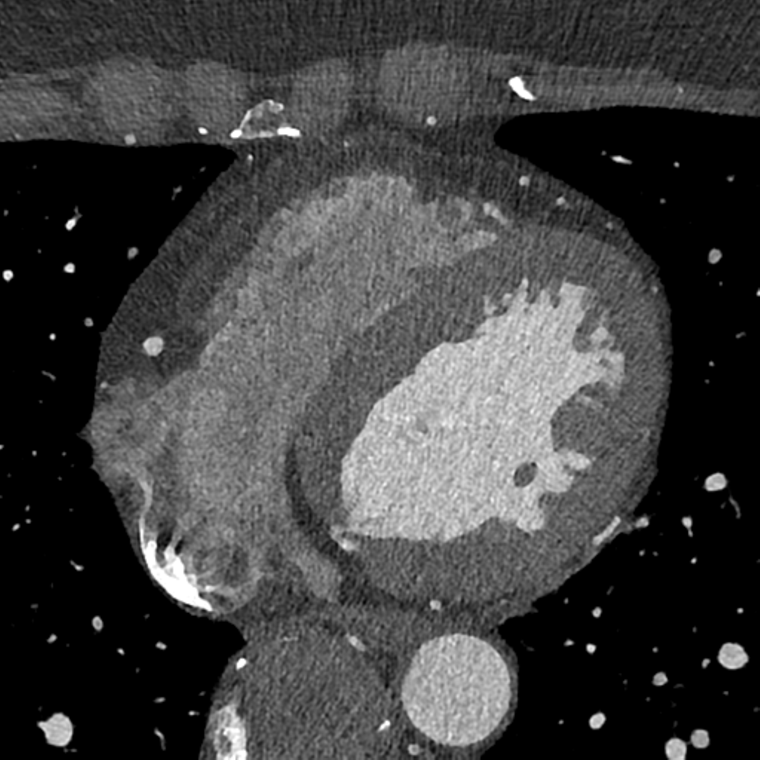 photon-counting-detector CTを使用した冠動脈CT angiographyの