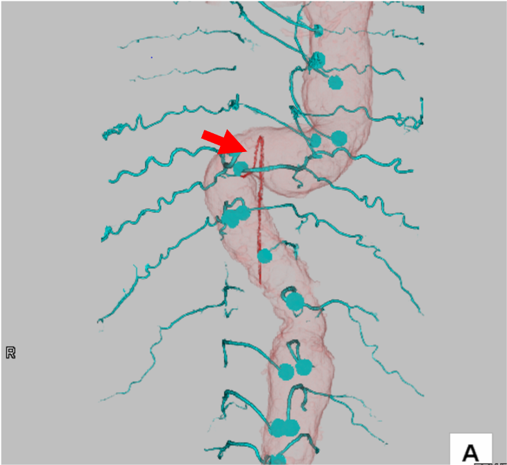 960px-AneurysmT.PNG