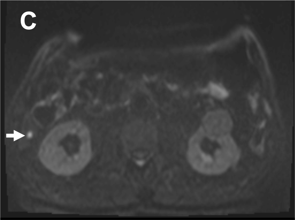 膵癌、EOB-MRIによる肝転移検索の重要性 ｜ Search Radiology ｜ 医療 