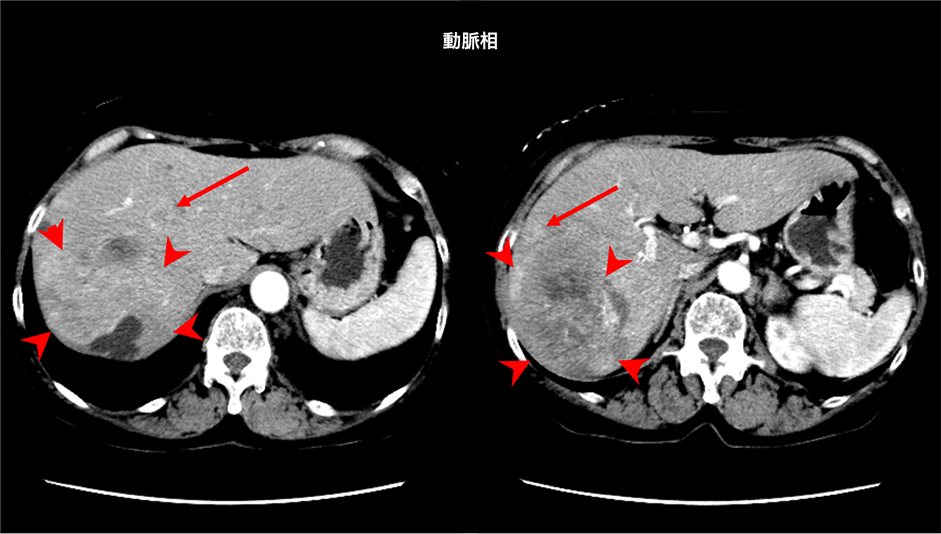 肝細胞癌、分子標的薬治療後の効果判定におけるEOB-MRIの有用性 