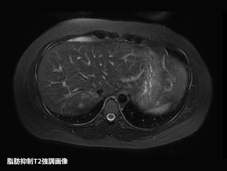 EOB-MRI/Sonazoid超音波による肝癌の診断と治療 EOB-MRI/Sonazoid 超音波による肝癌の診断と治療 | 工藤 正俊