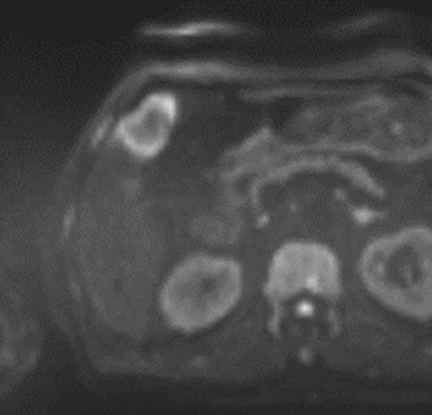 混合型肝癌の診断にEOB-MRIが有用であった1例 ｜ Search
