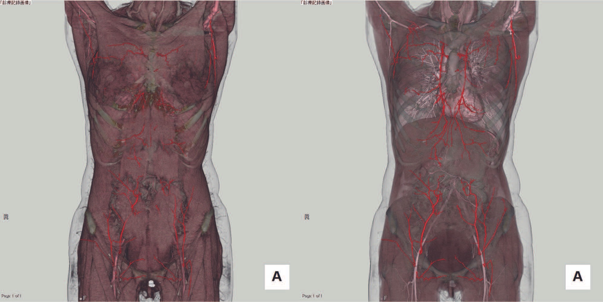 深下腹壁動脈穿通枝皮弁(DIEP flap)術前CTA | Search Radiology 深下腹壁動脈穿通枝皮弁(DIEP flap)術前CTA | Search Radiology