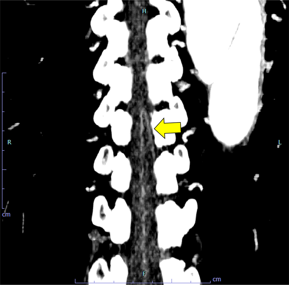 960px-AneurysmT.PNG